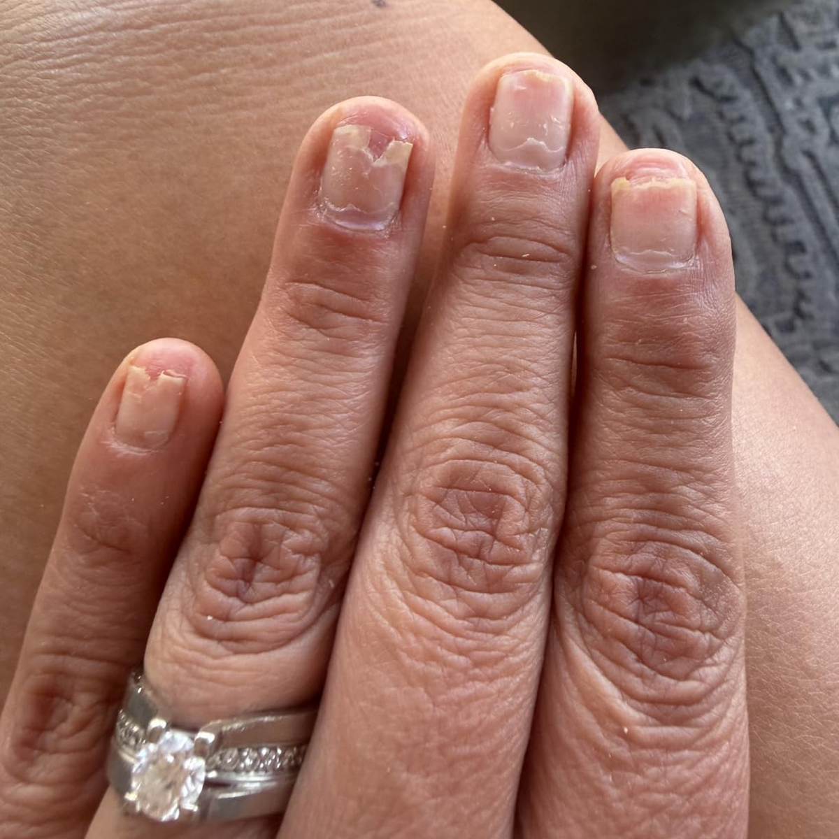 Before Duo Day & Night Nails Repair Treatment
