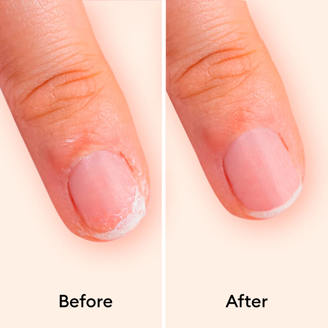 Nail repair treatment before and after - brittle nail strengthening results in 7 days